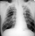 Pronosticos Mundiales sobre la Tuberculosis